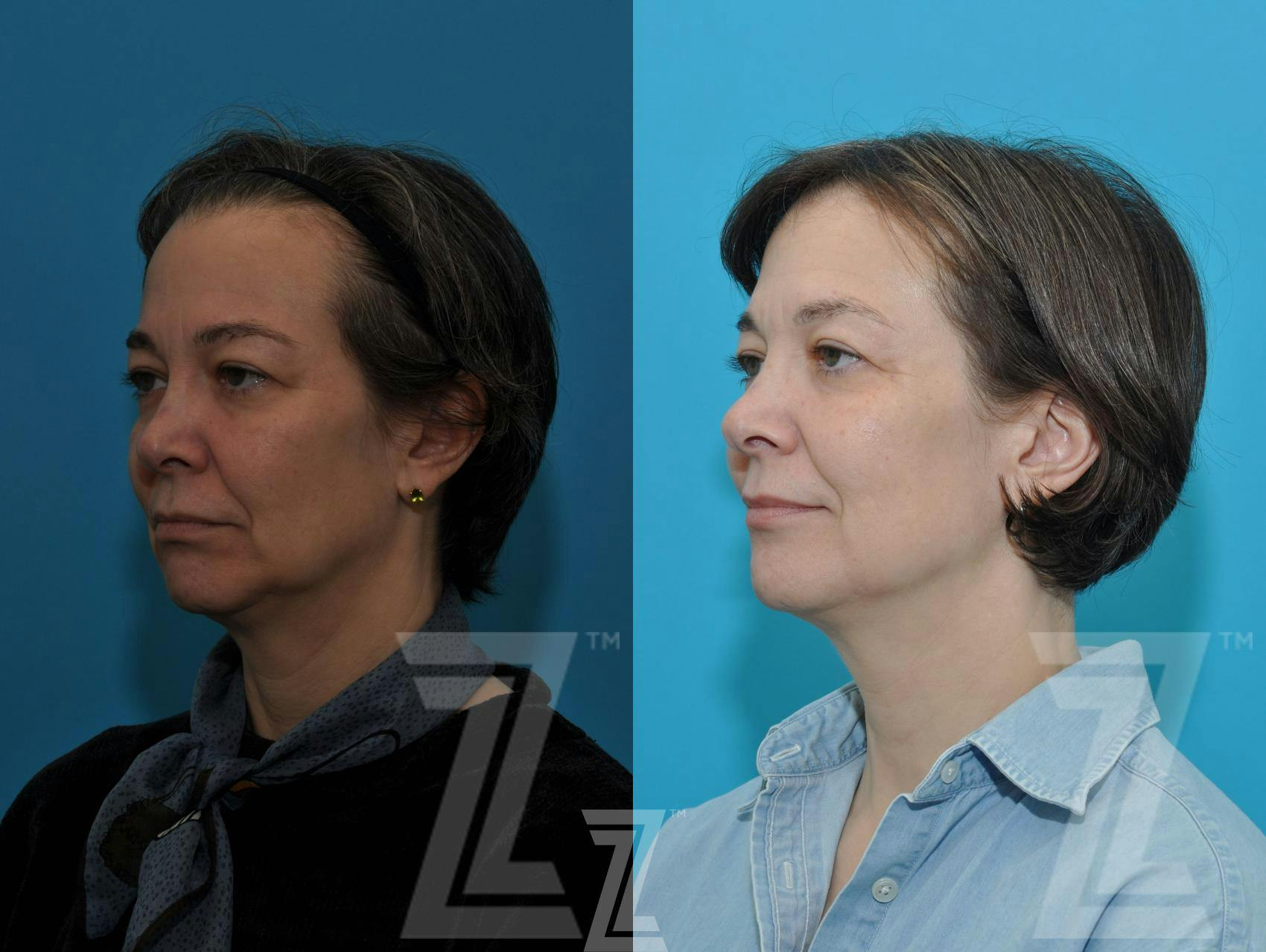 Sculptra® Before & After Gallery - Patient 132963131 - Image 2