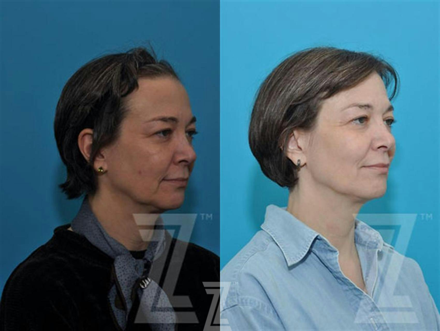 Sculptra® Before & After Gallery - Patient 132963131 - Image 3
