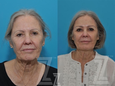 Sculptra® Before & After Gallery - Patient 132963132 - Image 1