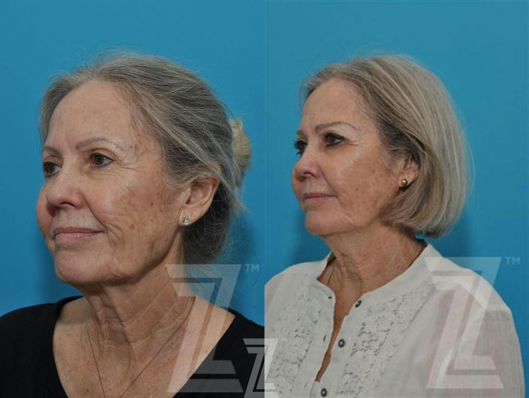 Sculptra® Before & After Gallery - Patient 132963132 - Image 2