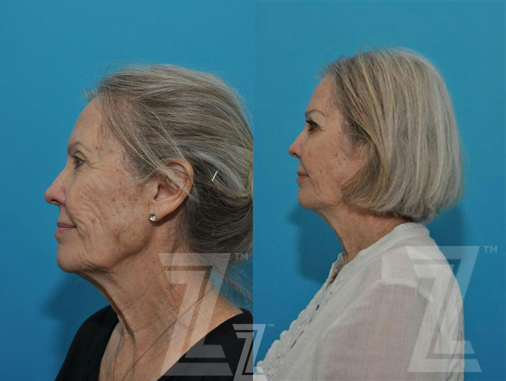 Sculptra® Before & After Gallery - Patient 132963132 - Image 3