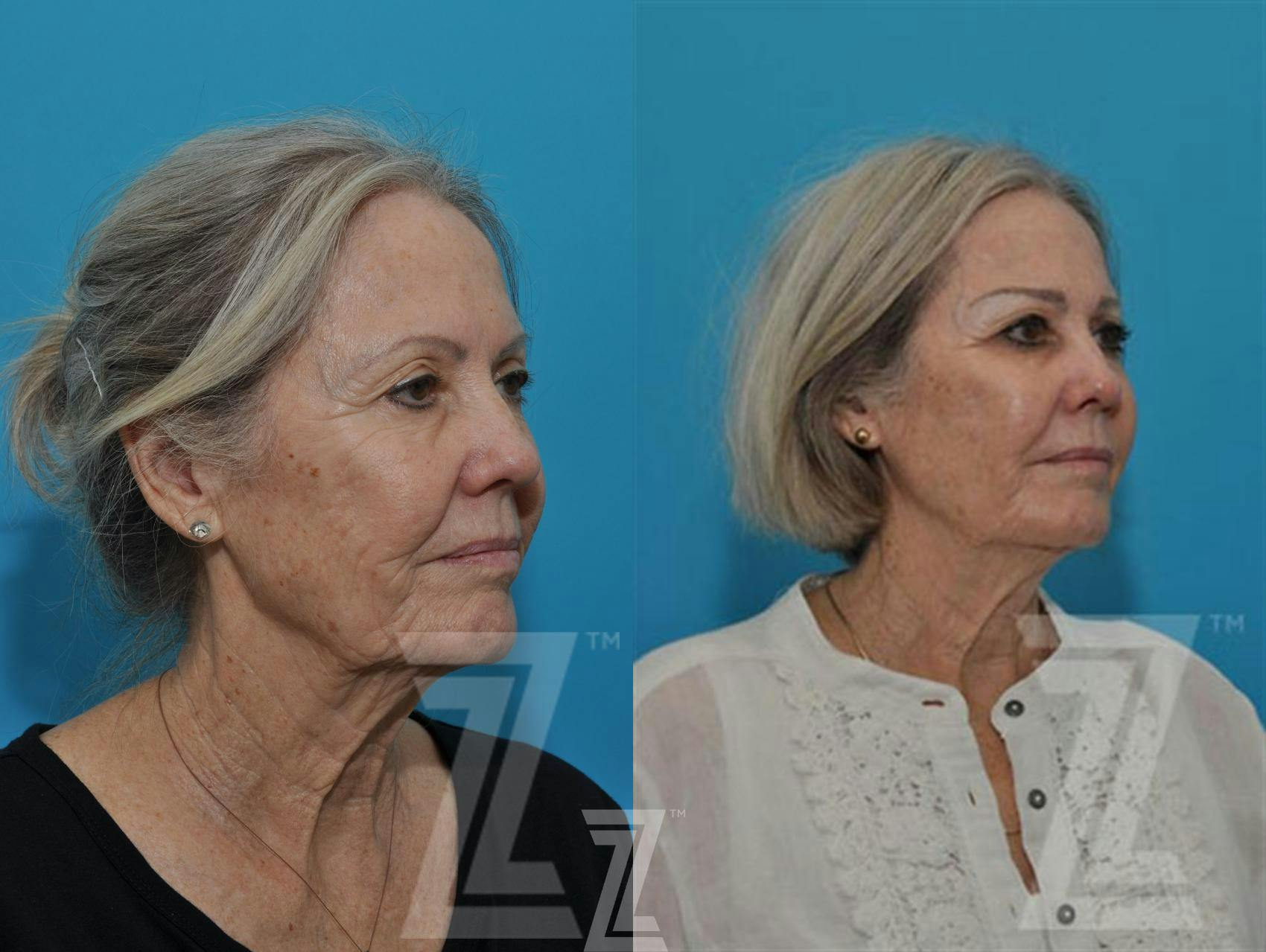 Sculptra® Before & After Gallery - Patient 132963132 - Image 4