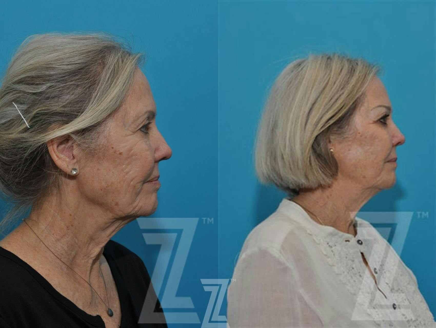 Sculptra® Before & After Gallery - Patient 132963132 - Image 5