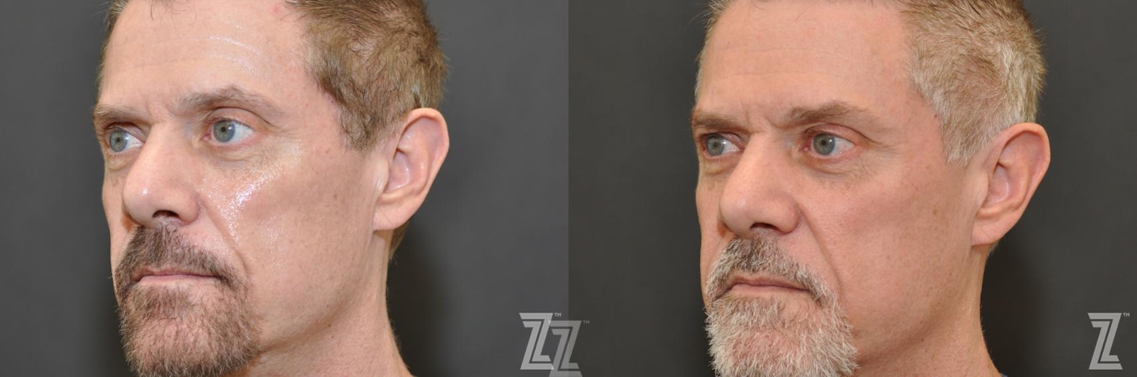 Austin Sculptra® Before & After Gallery - Patient 132963133 - Image 1 - The Piazza Center