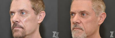 Austin Male Injectables Before & After Gallery - Patient 248412 - Image 1 - The Piazza Center