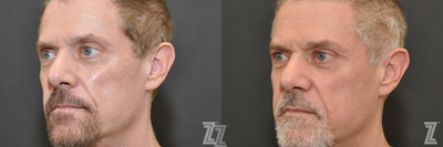 Sculptra® Before & After Gallery - Patient 132963133 - Image 1