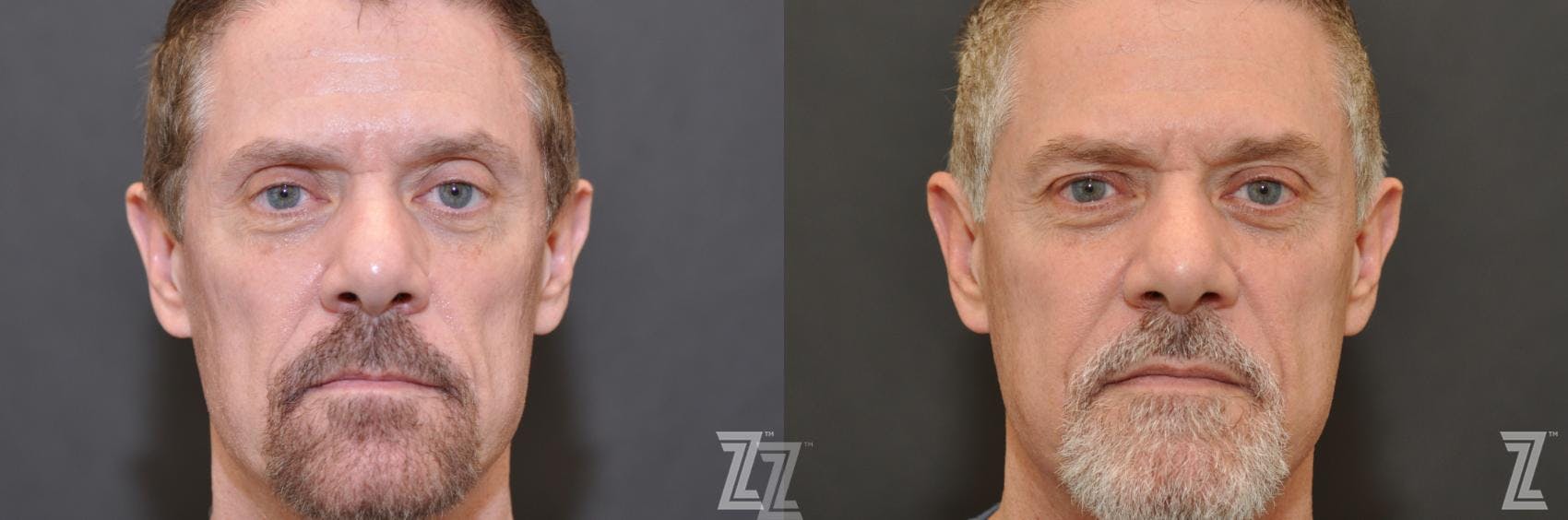 Sculptra® Before & After Gallery - Patient 132963133 - Image 2