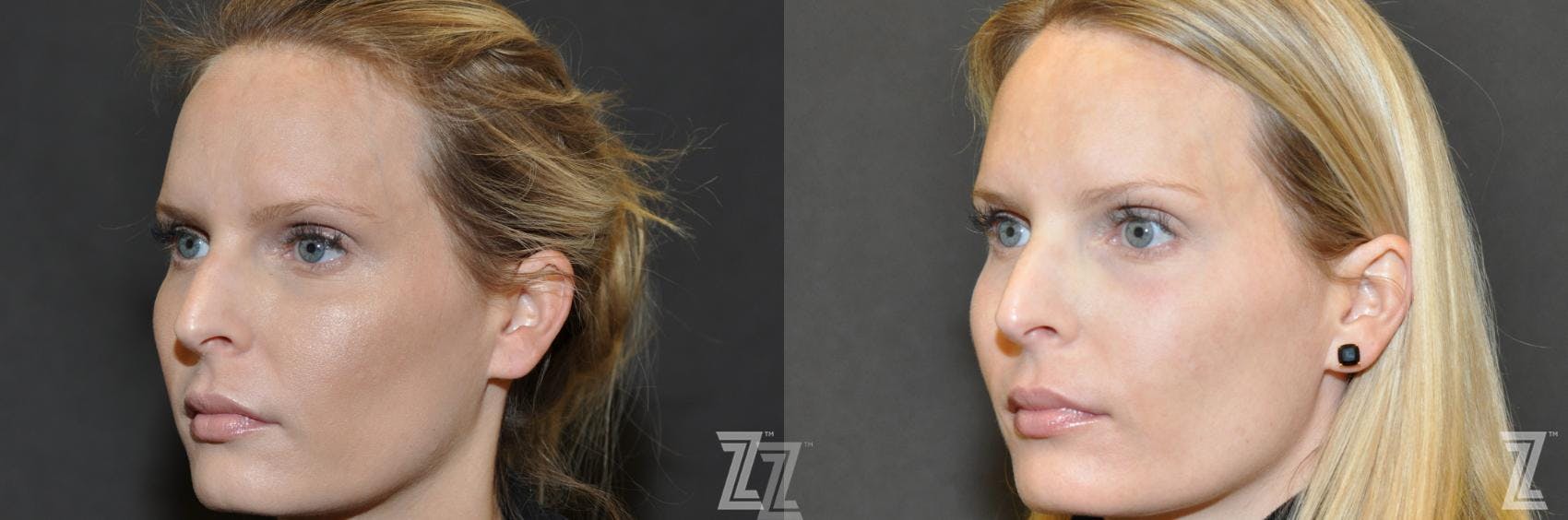 Sculptra® Before & After Gallery - Patient 132963134 - Image 1