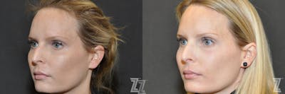 Austin Sculptra® Before & After Gallery - Patient 132963134 - Image 1 - The Piazza Center