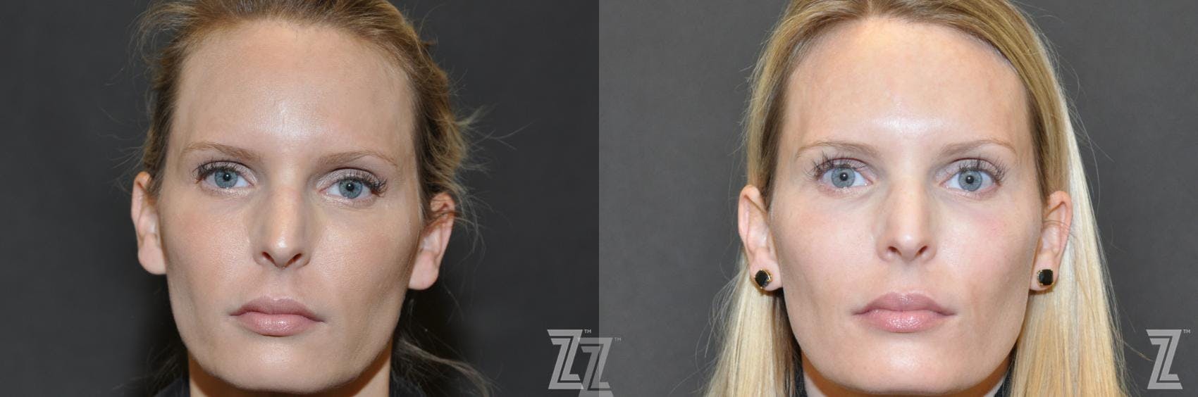 Sculptra® Before & After Gallery - Patient 132963134 - Image 2
