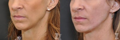 Austin Sculptra® Before & After Gallery - Patient 132963135 - Image 1 - The Piazza Center