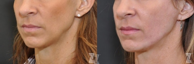 Sculptra® Before & After Gallery - Patient 132963135 - Image 1