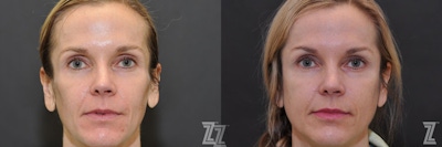Sculptra® Before & After Gallery - Patient 132963136 - Image 1