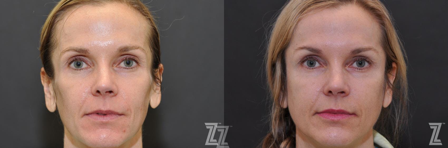 Sculptra® Before & After Gallery - Patient 132963136 - Image 1