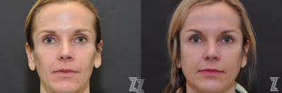 Austin Sculptra® Before & After Gallery - Patient 132963136 - Image 1 - The Piazza Center