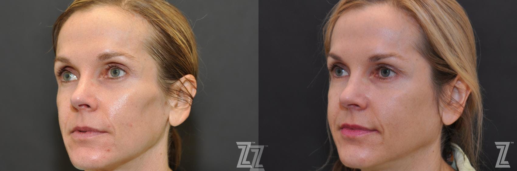 Sculptra® Before & After Gallery - Patient 132963136 - Image 2
