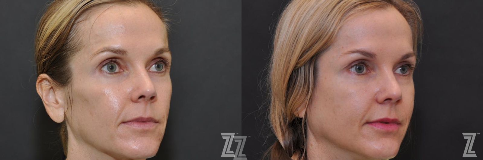 Austin Sculptra® Before & After Gallery - Patient 132963136 - Image 3 - The Piazza Center