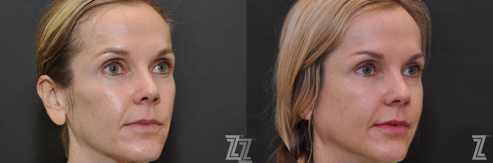 Sculptra® Before & After Gallery - Patient 132963136 - Image 3