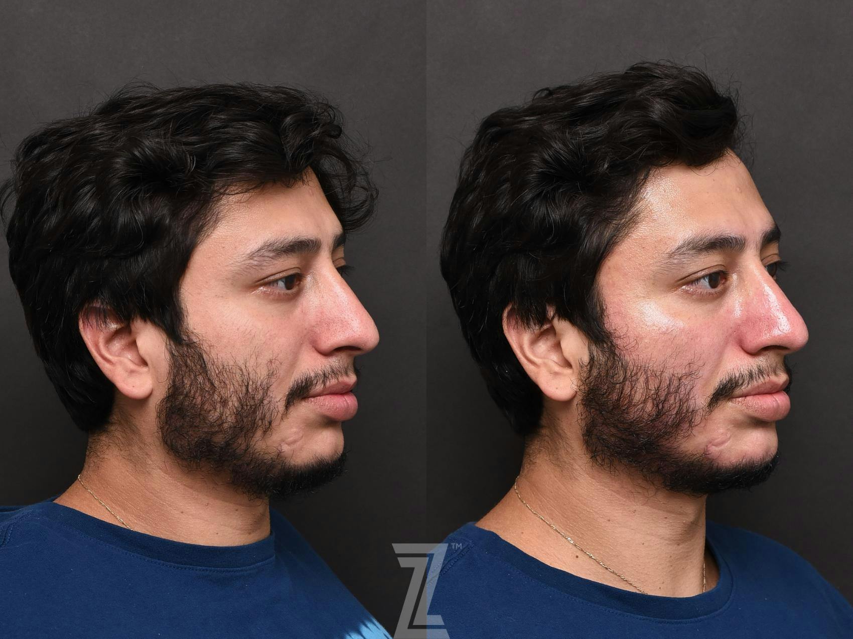 HydraFacial™ Before & After Gallery - Patient 132963244 - Image 2