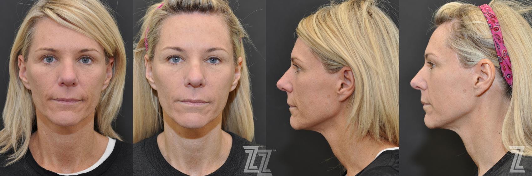 Chemical Peel Before & After Gallery - Patient 132963245 - Image 1