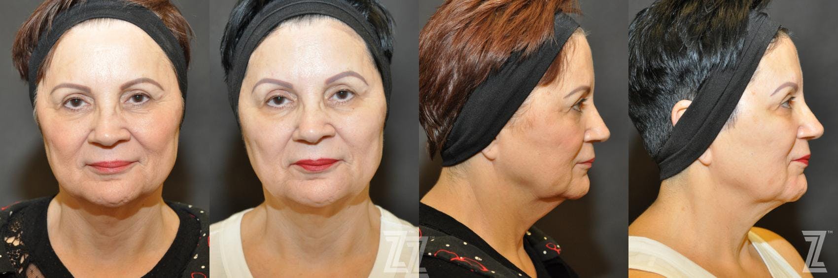 Chemical Peel Before & After Gallery - Patient 132963247 - Image 1