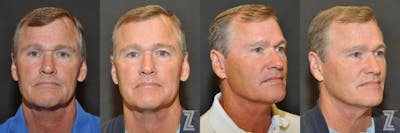 Austin Male Skin Treatments Before & After Gallery - Patient 220662 - Image 1 - The Piazza Center