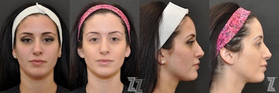 Chemical Peel Before & After Gallery - Patient 132963250 - Image 1