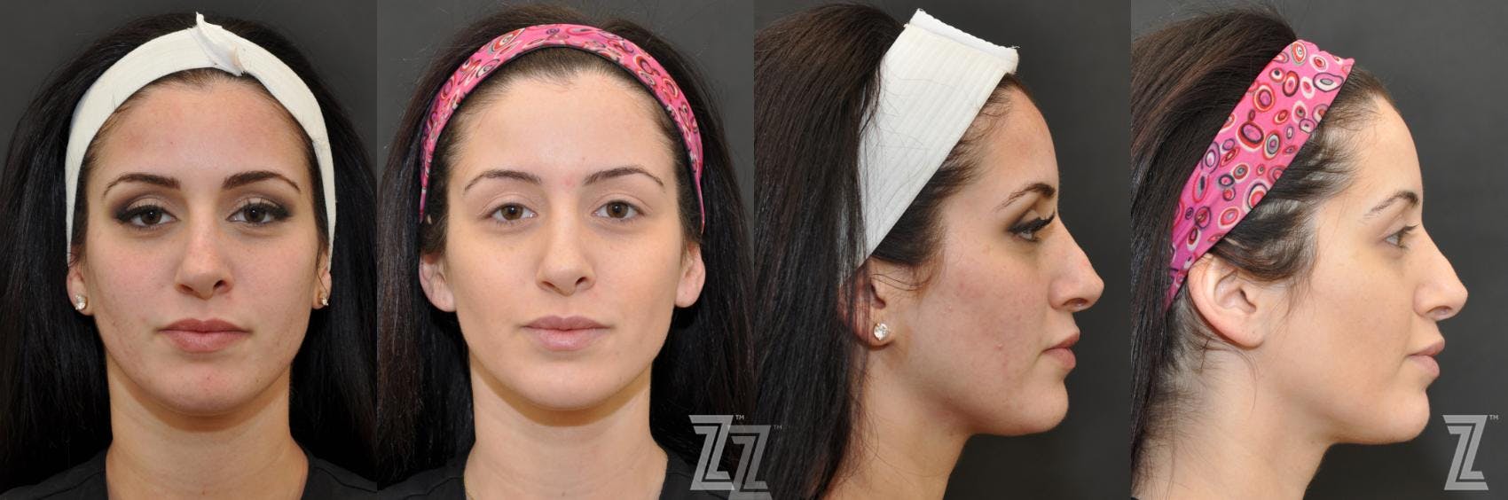 Chemical Peel Before & After Gallery - Patient 132963250 - Image 1