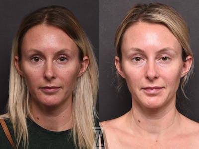 Austin BBL Before & After Gallery - Patient 132963253 - Image 1 - The Piazza Center