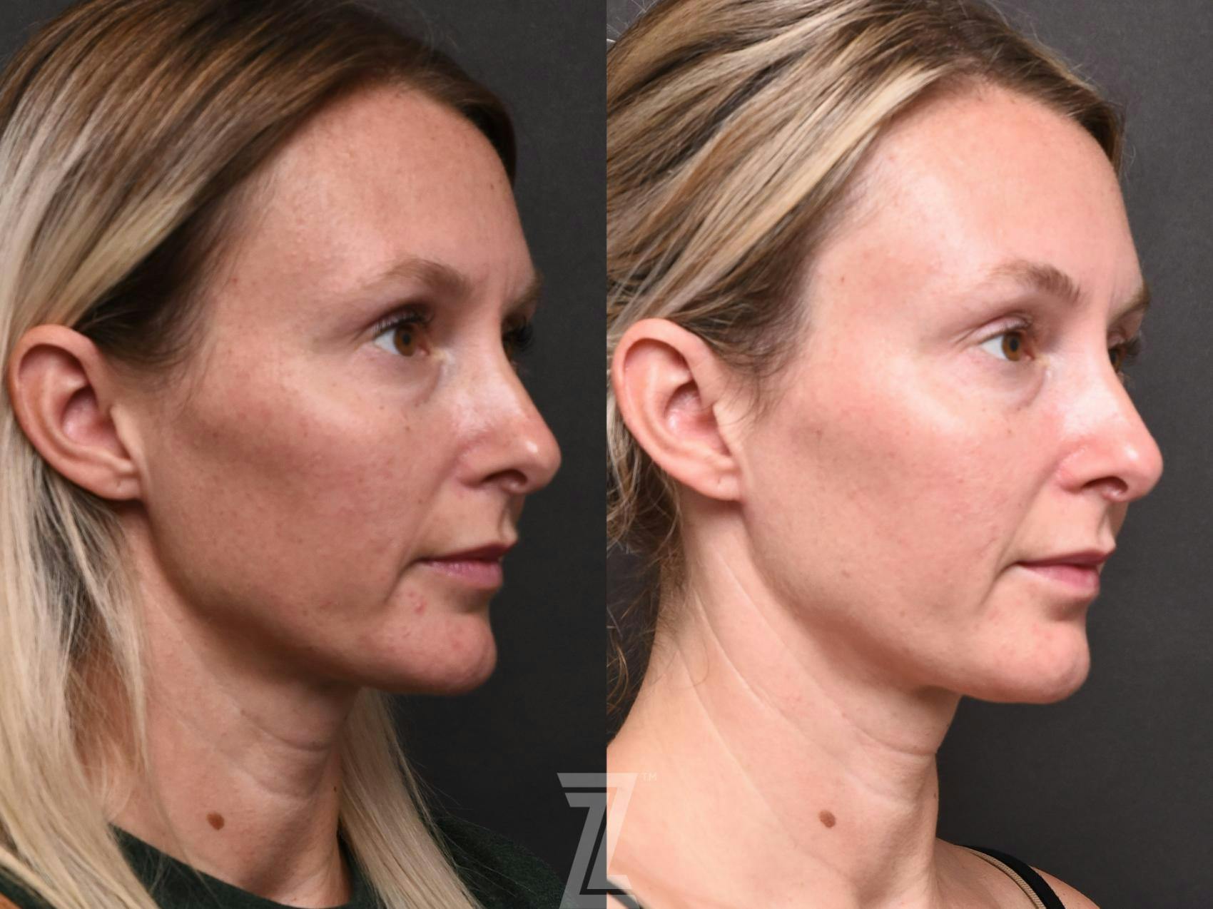 BBL Before & After Gallery - Patient 132963253 - Image 2