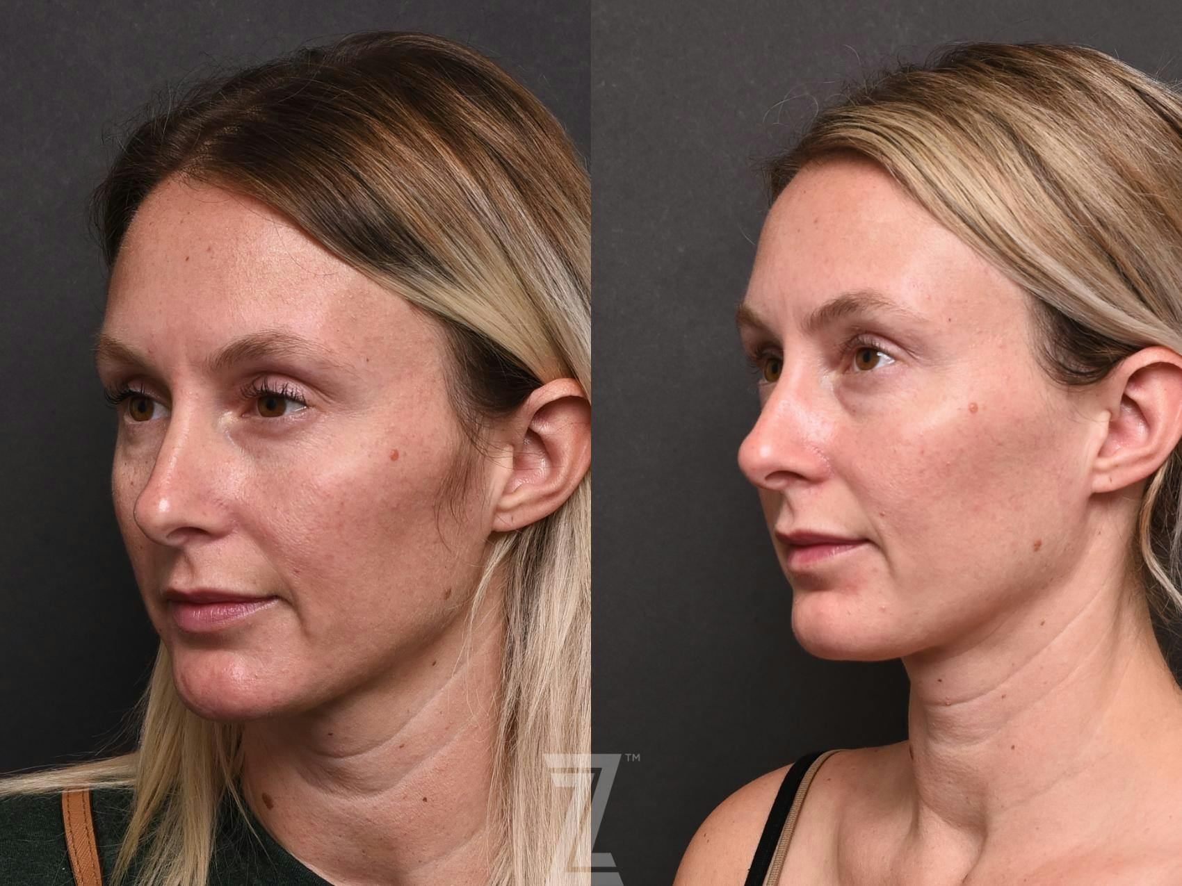 BBL Before & After Gallery - Patient 132963253 - Image 3