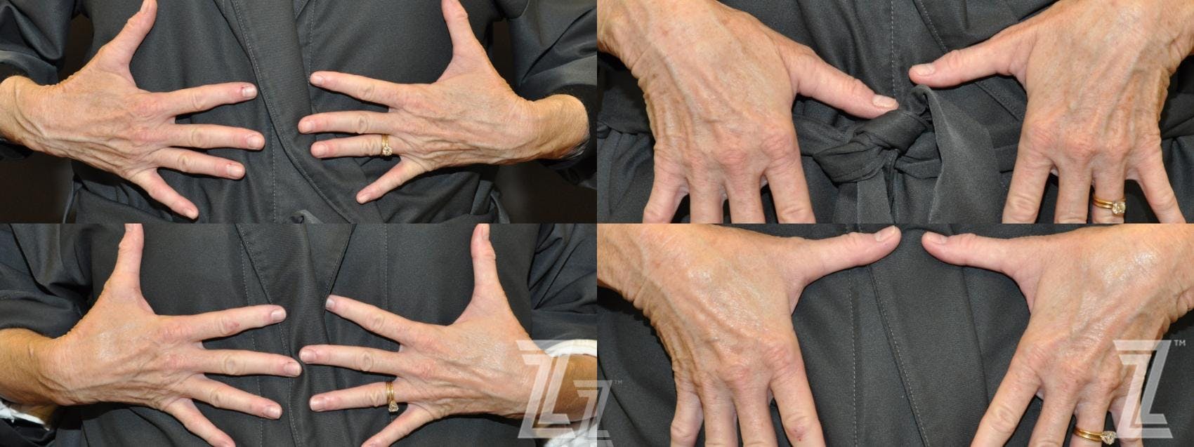 BBL Before & After Gallery - Patient 132963254 - Image 1
