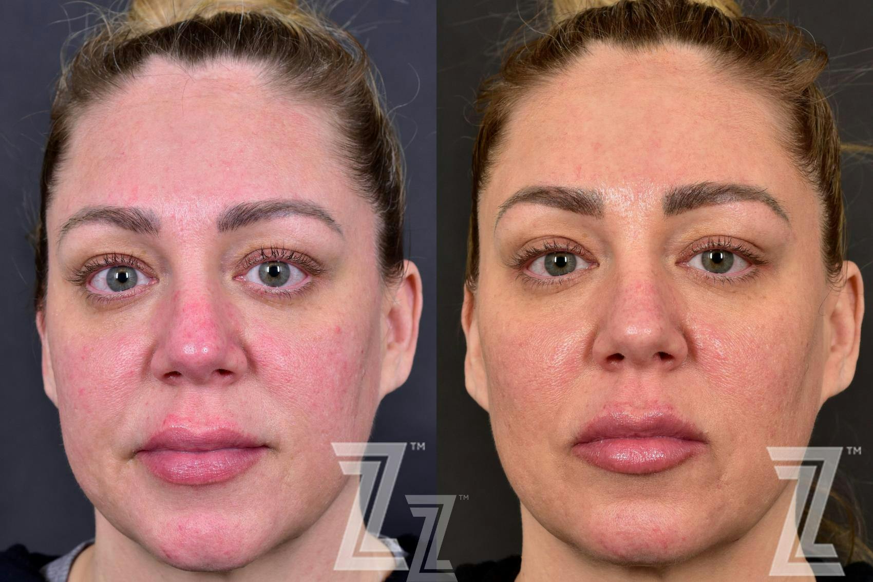 BBL Before & After Gallery - Patient 132963256 - Image 1