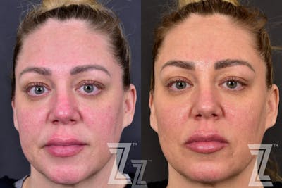 Austin BBL Before & After Gallery - Patient 132963256 - Image 1 - The Piazza Center