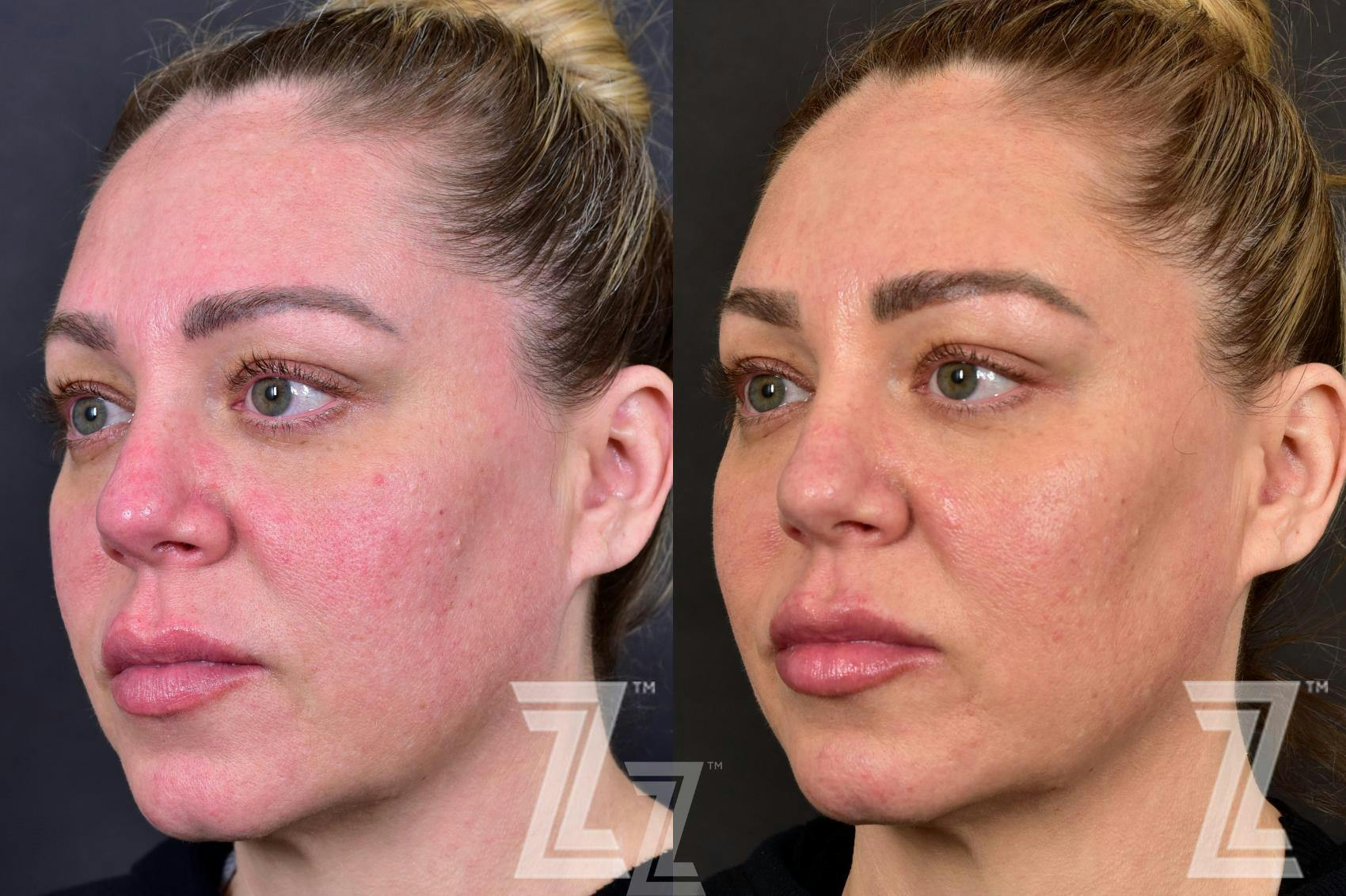 BBL Before & After Gallery - Patient 132963256 - Image 2
