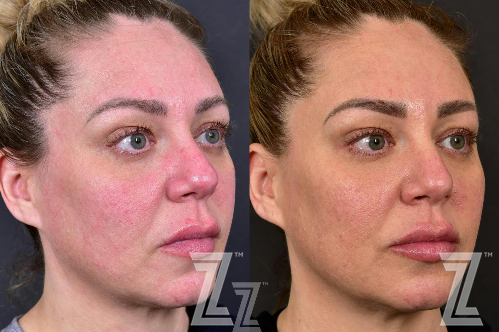 BBL Before & After Gallery - Patient 132963256 - Image 3