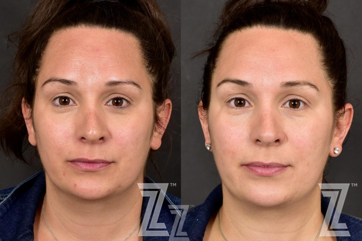 Austin HALO Before & After Gallery - Patient 132963258 - Image 1 - The Piazza Center