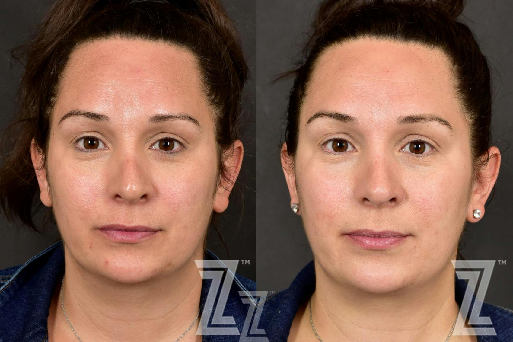 HALO Before & After Gallery - Patient 132963258 - Image 1