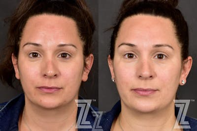 Austin HALO Before & After Gallery - Patient 132963258 - Image 1 - The Piazza Center