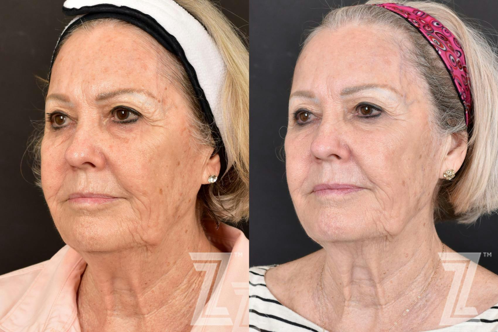 HALO Before & After Gallery - Patient 132963261 - Image 2