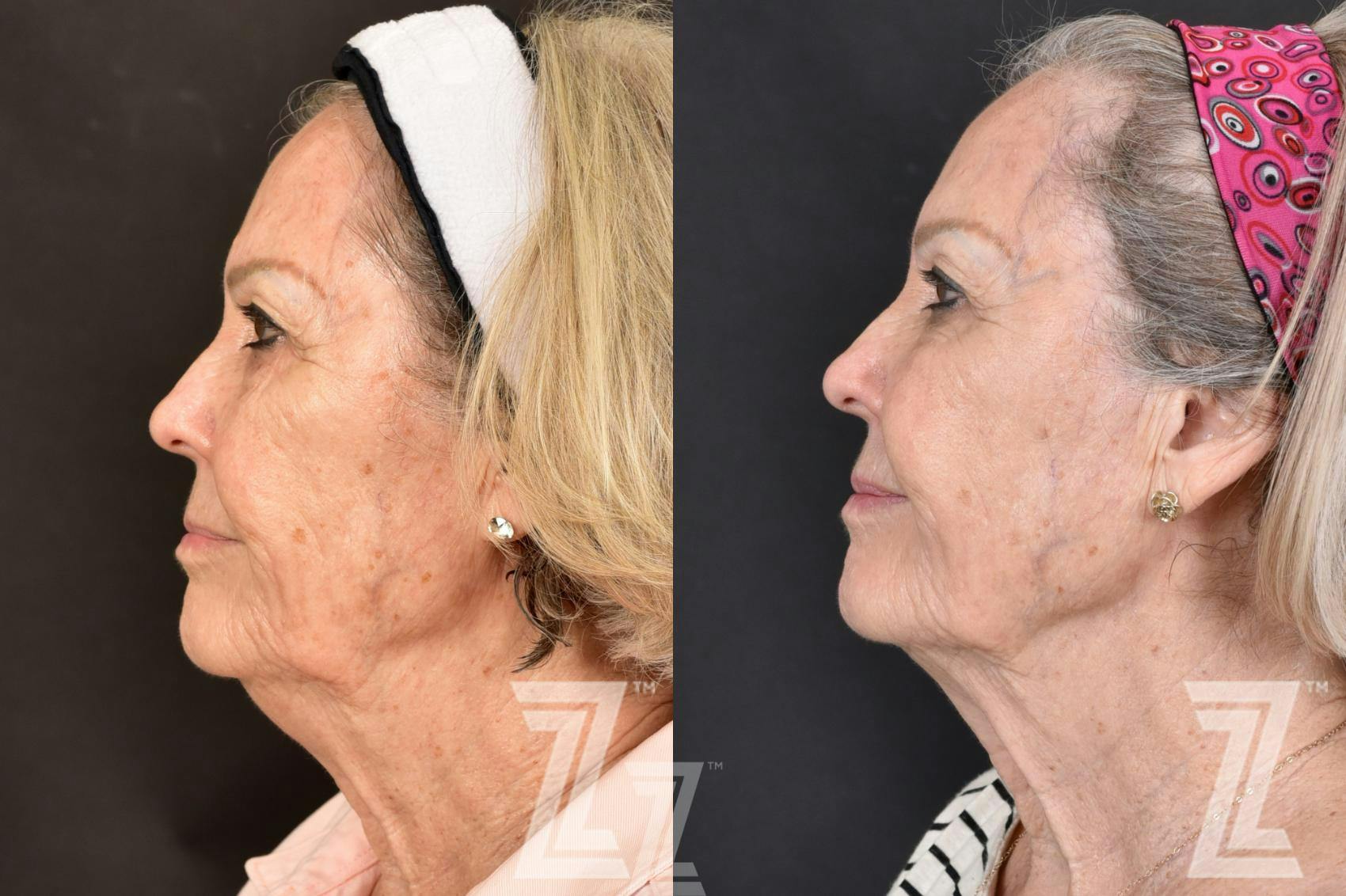 HALO Before & After Gallery - Patient 132963261 - Image 3