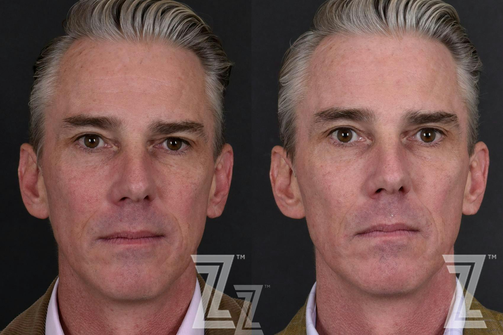 HALO Before & After Gallery - Patient 132963262 - Image 1