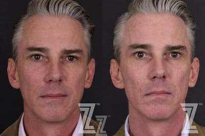 Austin HALO Before & After Gallery - Patient 132963262 - Image 1 - The Piazza Center