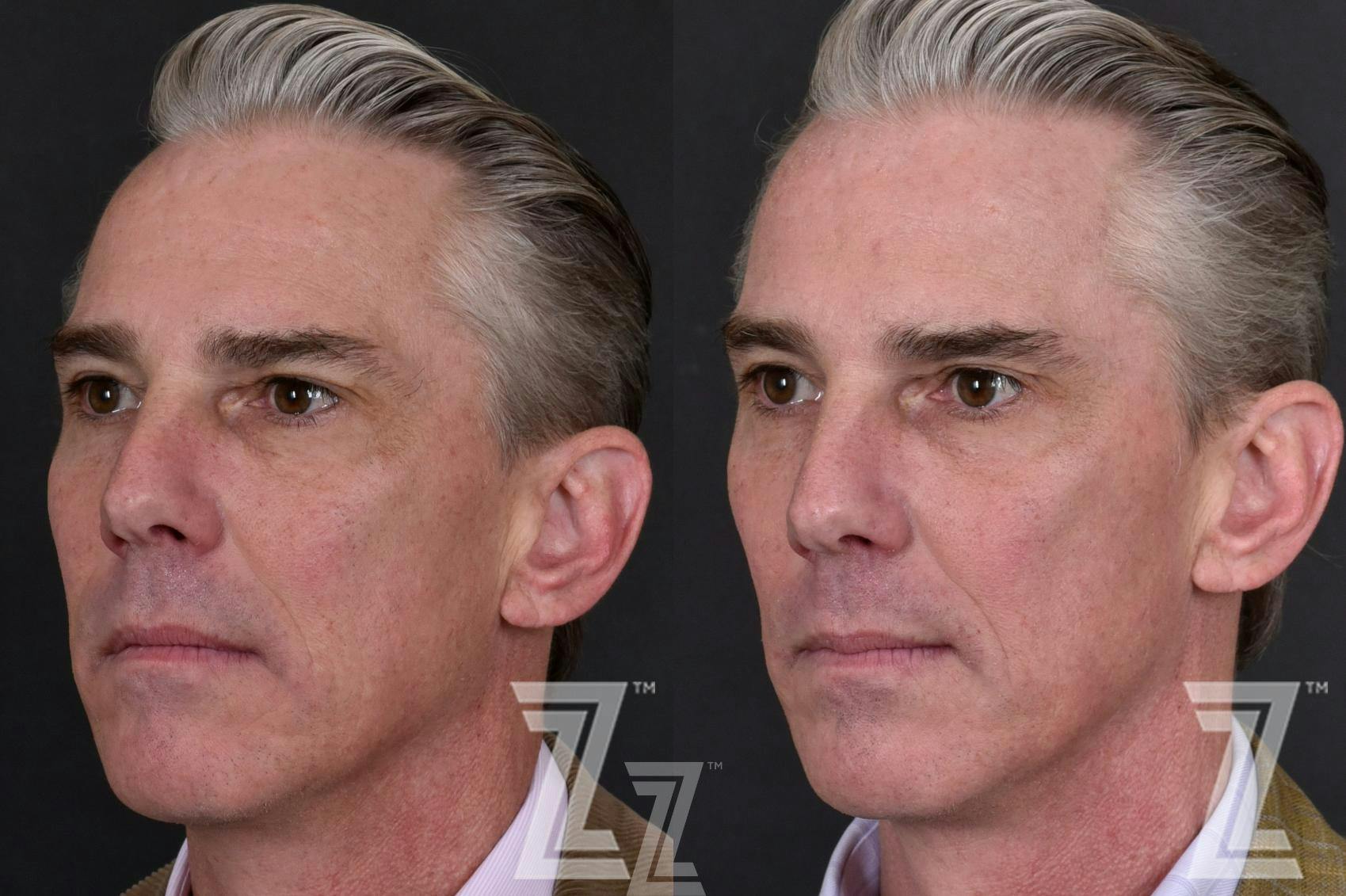 HALO Before & After Gallery - Patient 132963262 - Image 2