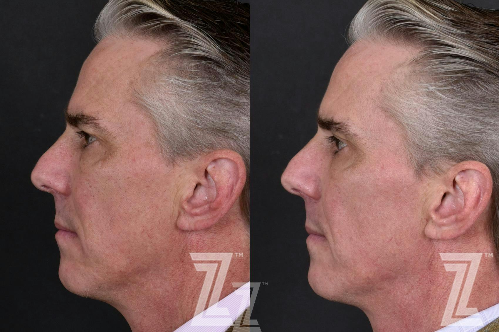 HALO Before & After Gallery - Patient 132963262 - Image 3