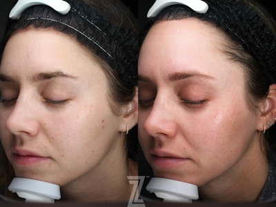 Visia Skincare Analysis Before & After Gallery - Patient 132963263 - Image 1