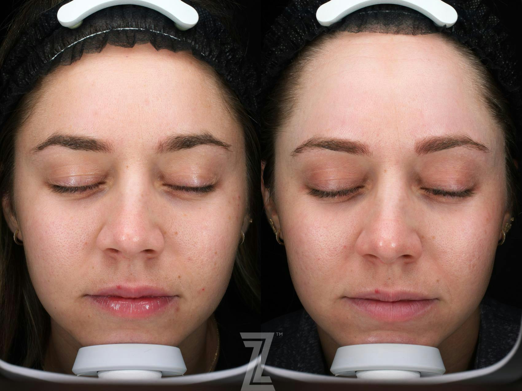 Visia Skincare Analysis Before & After Gallery - Patient 132963263 - Image 2