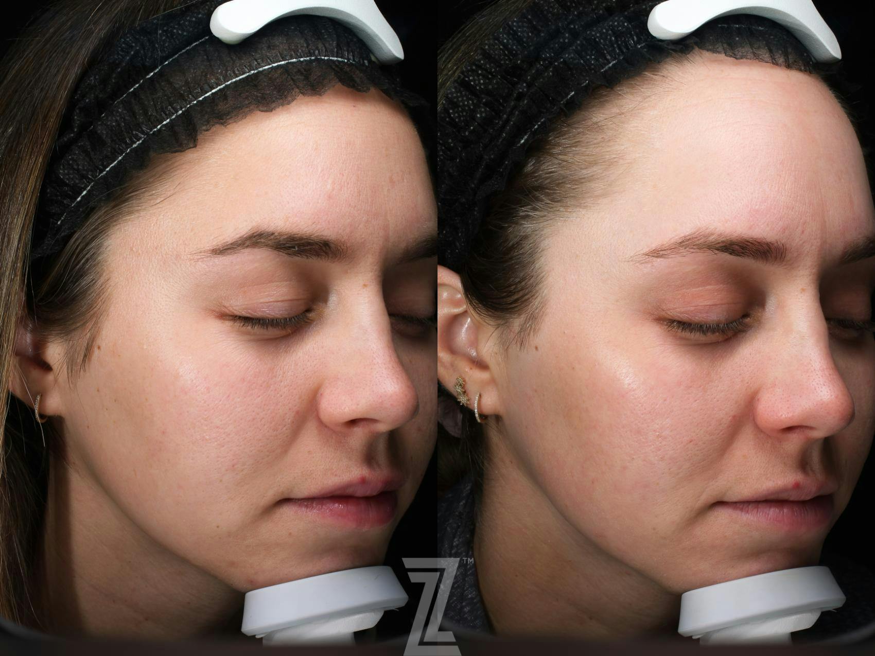 Visia Skincare Analysis Before & After Gallery - Patient 132963263 - Image 3