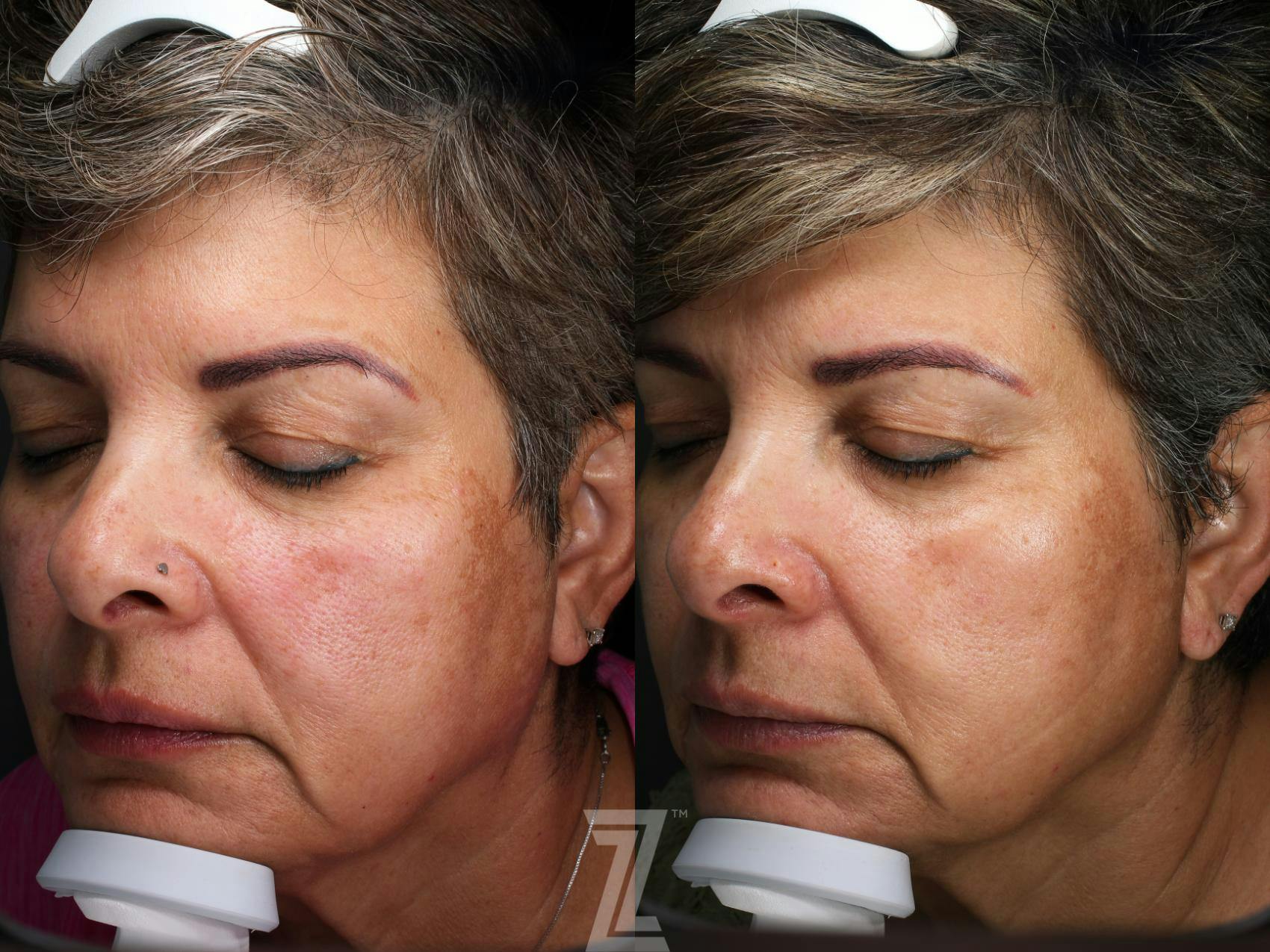 Visia Skincare Analysis Before & After Gallery - Patient 132963266 - Image 1