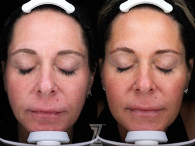 Visia Skincare Analysis Before & After Gallery - Patient 132963268 - Image 1